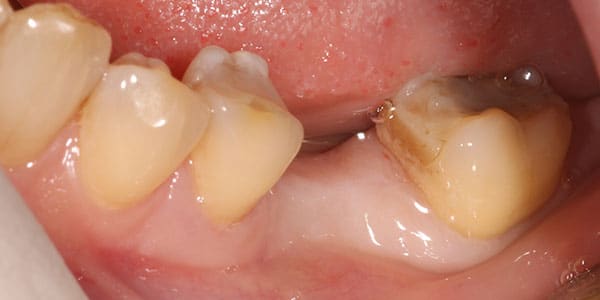 Missing single back tooth