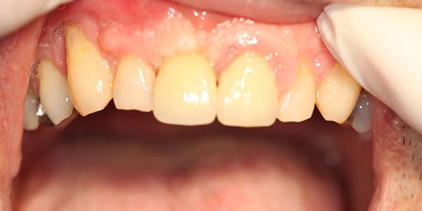 replaced missing front tooth with a dental implants