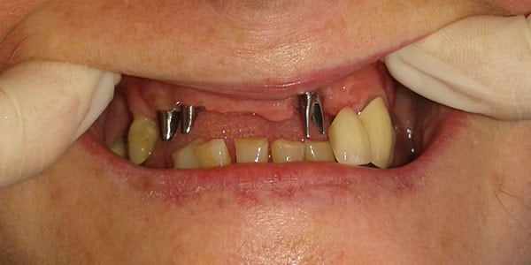 Bristol Patient missing multiple front teeth