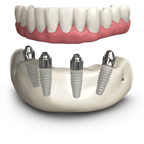 All on 4 Dental Implants